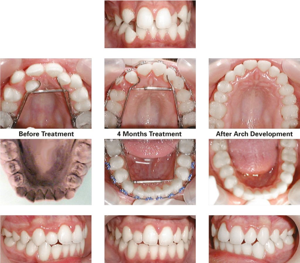 Transverse and Sagittal Case Studies - TransForce Orthodontics