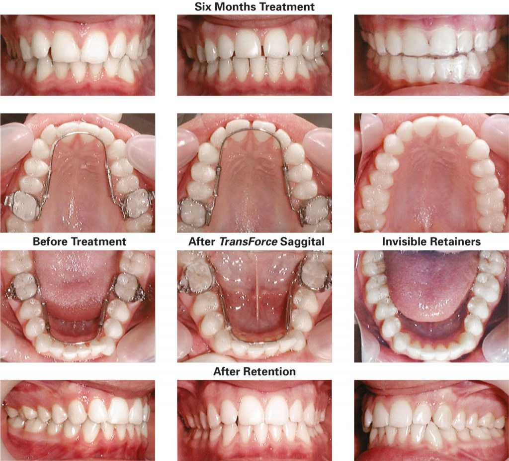 TransForce Sagittal Expander - TransForce Orthodontics - Dr William Clark