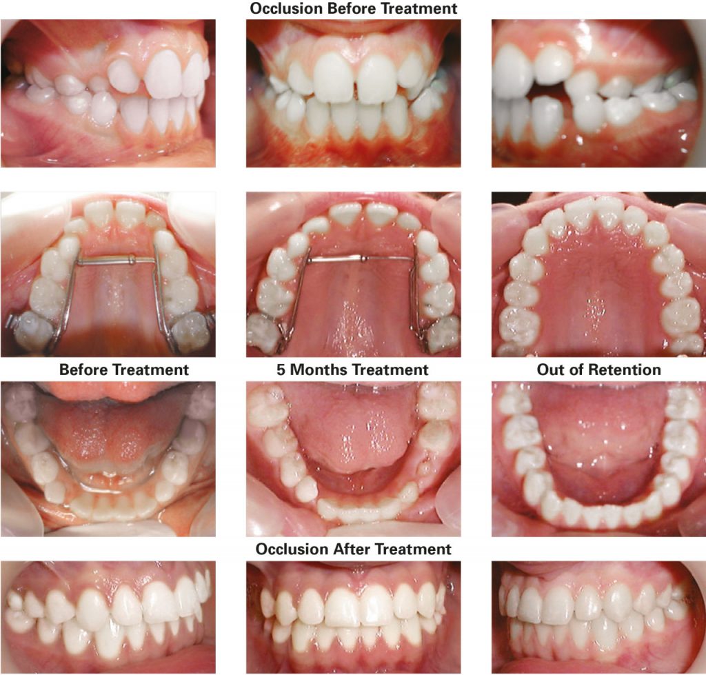 TransForce Palatal Expander - TransForce Orthodontics - Dr William Clark