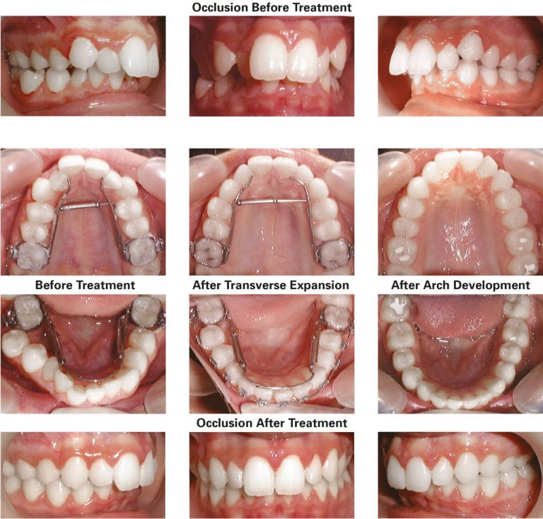 Transverse and Sagittal Case Studies - TransForce Orthodontics