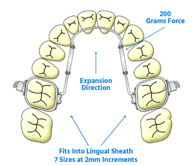 TransForce Sagittal Expander - TransForce Orthodontics - Dr William Clark